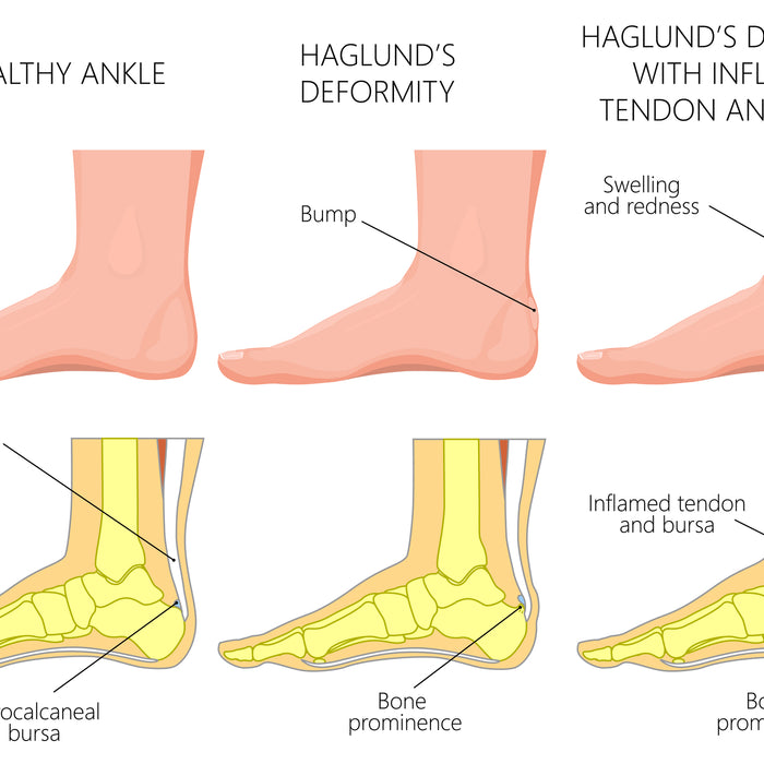 Best Shoes For Haglund's Deformity