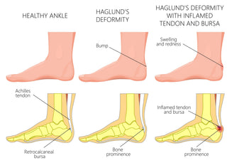 Best Shoes For Haglund's Deformity